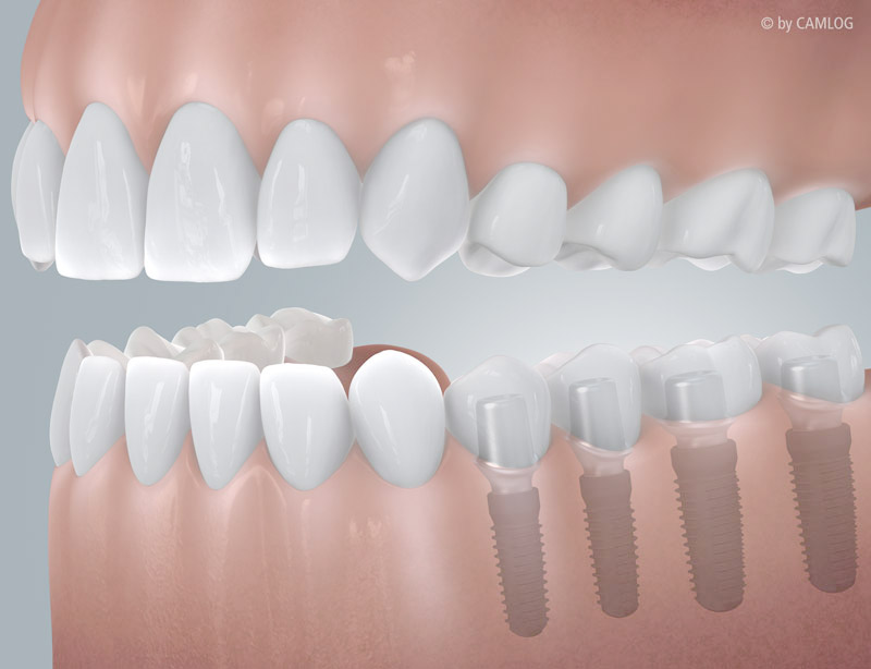 CAMLOG_Freiendluecke_mit_Implantatversorgung_c